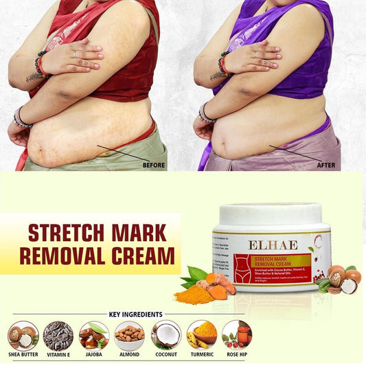 Stretch Mark Removal Cream